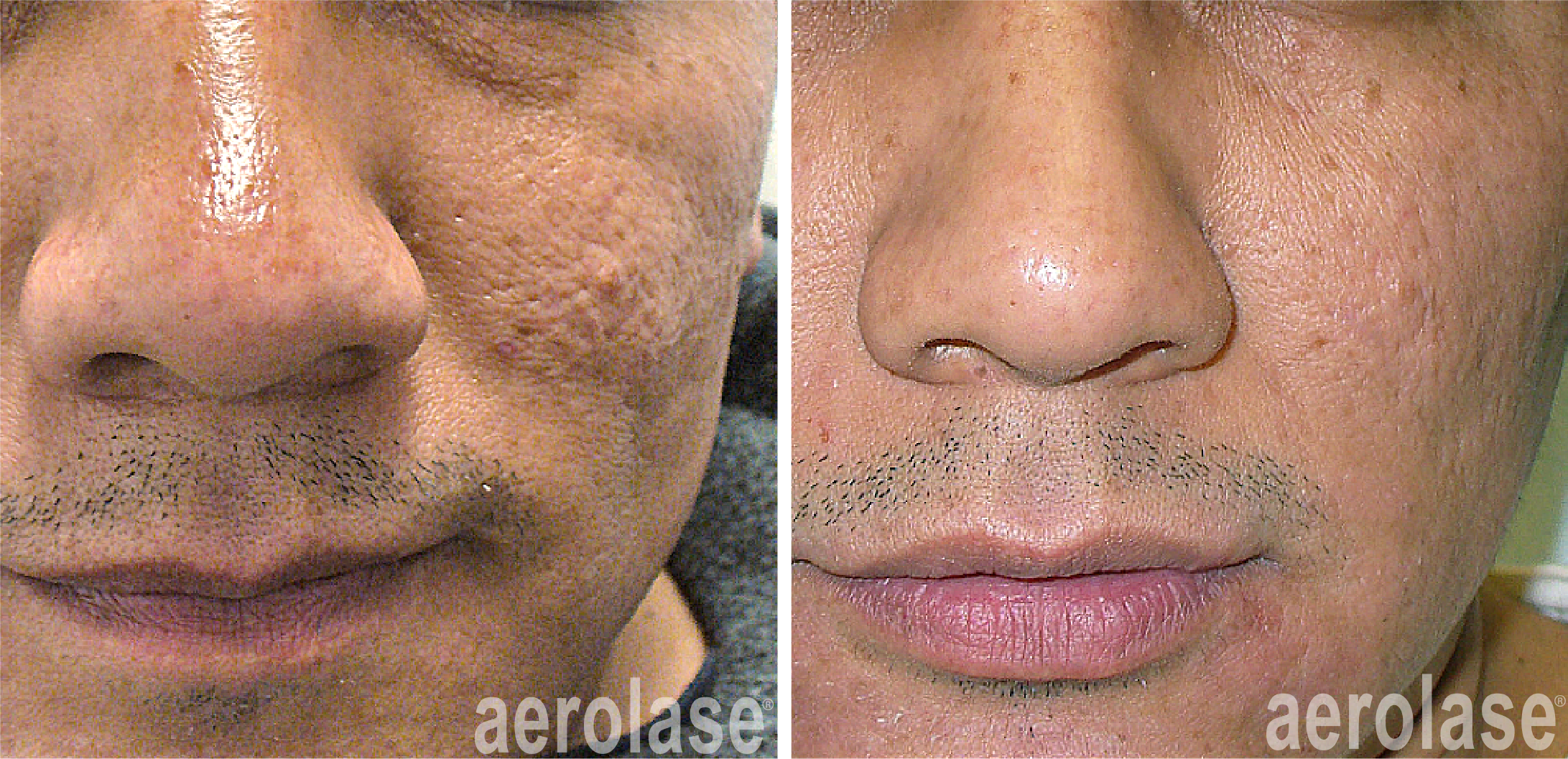 aerolase-skin-rejuvenation-fran cook bolden-after-7-treatments